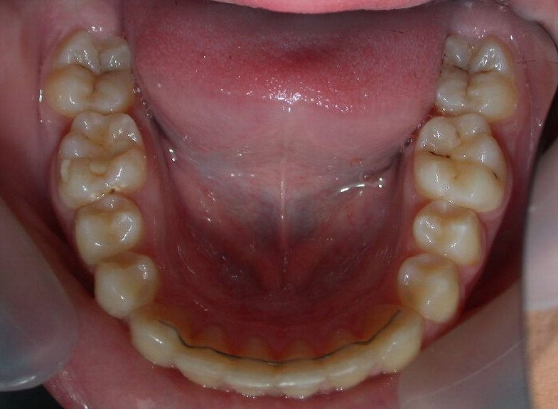 procedure_3